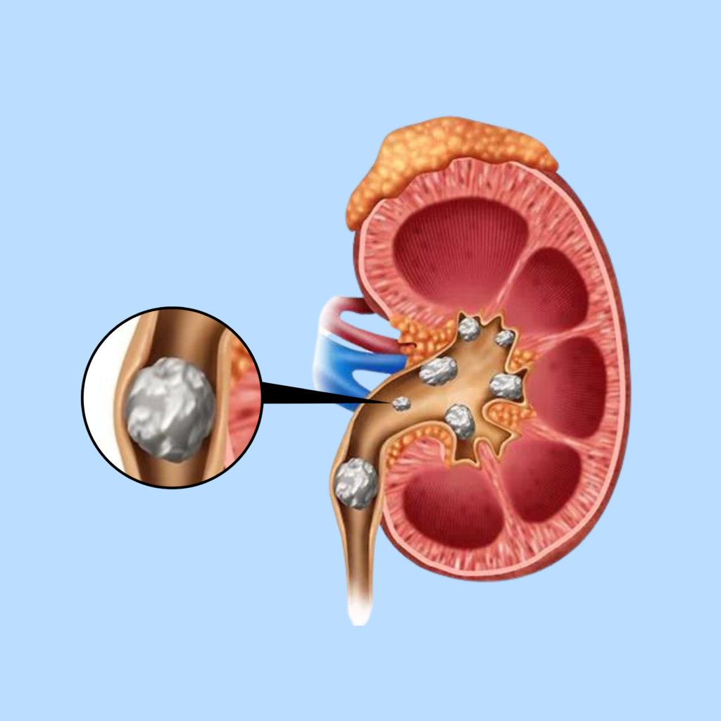 Is Surgery Required for Kidney Stones? What Type of Surgery is the Best Option?